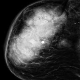 CC view shows two contiguous masses. the largest one occupied almost the whole breast,is hyperdense of irregular shape with o