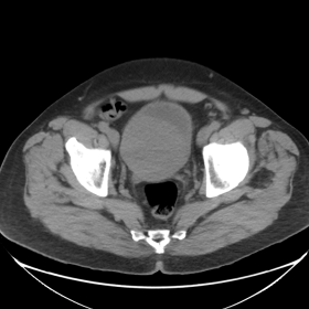 CE-CT of the abdomen/pelvic area, axial. Well defined, slightly enhancing tumor in