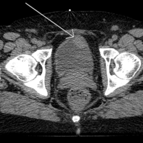 Axial non-contrast CT demonstrates a nodular isointense lesion of the bladder wall