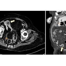 Day 1: axial and coronal sections of an i.v. contrast-enhanced CT scan (portal phase) of the abdomen showing enlarged small b
