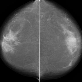 CC (a) and MLO (b) mammograms show mammary glands with scattered areas of fibroglandular density (BI-RADS density B). Bilater