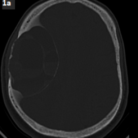 Axial CT images show a multiloculated lytic expansile lesion in the right parietal bone with marked thinning of the inner and