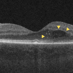 Optical coherence tomography of the left eye shows residual choroidal melanoma mass (arrows) with adjacent fluid collection i