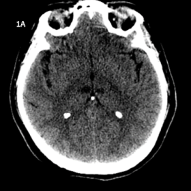 Computed tomography (CT) axial acquisition: Bilateral paramedian thalamic hypodensities with extension to the tegmentum of th