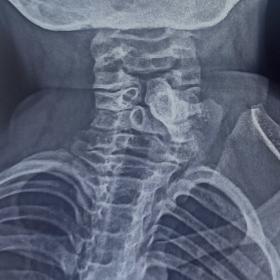AP radiograph cervical spine showing osseous structure overlying left lamina C4 and C5 with lateral extension.Spina bifida wa