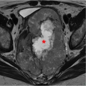 Axial (a), coronal (b) and sagittal (c) T2-WI showing a large lobulated exophytic rectal mass, which deviates the rectum and 