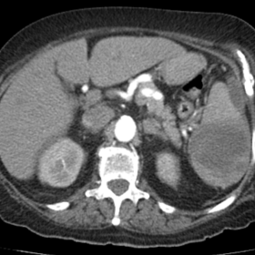 CT image of Infiltrative hypodense changes and enlargement of the spleen