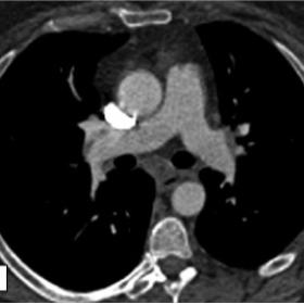 CT angiography shows no evidence of chronic or acute pulmonary embolism and the pulmonary artery trunk is within normal size 