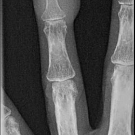 4th left finger AP radiograph performed shortly after the patient pricked himself with a rose thorn. Soft tissue enlargement 