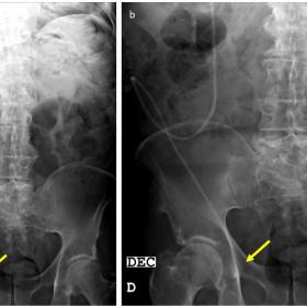 a. Abdominal simple X-Ray erect position that shows ventriculoperitoneal derivation catheter (arrow) with inferior direction 