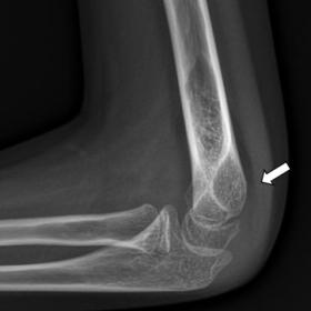Lateral radiography of the left elbow image shows joint with displacement of the posterior fat pad (white arrows) in keeping 
