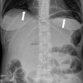 Erect radiography showing pneumoperitoneum (arrows)