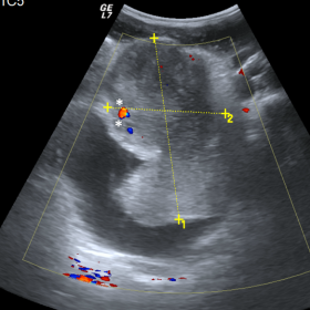 Urinary bladder ultrasound. Heterogeneous lobulated mass, with 10x6cm, invading the anterior bladder wall, with intra and ext