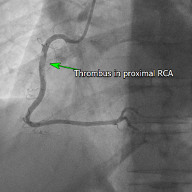 Angiogram showing Thrombus in proximal RCA