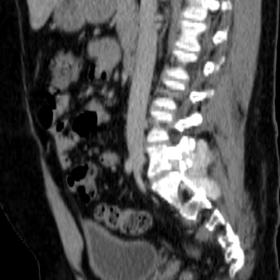 Sagittal CT image showing a hyperdense soft-tissue mass and erosive change at the level of the right L5 neural foramen and ri
