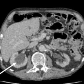 Axial CT images demonstrating bilateral hydronephrosis and dilated proximal ureters (arrow)