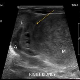 Gray scaleUSG abdomen shows well defined heterogeneous solid mass arising from lower pole of right kidney. M= renal mass. A =
