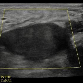 Ultrasound colour doppler right testicle. The image shows a homogenous, low-level, fine granular echotexture of the testicle 