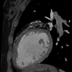 Oblique sagital cardiac CT image shows the focal aneurysm of proximal left anterior descending artery