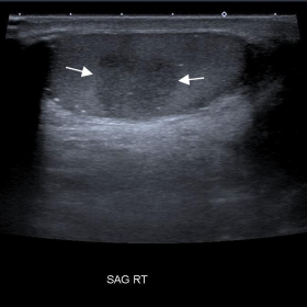 Sagittal greyscale ultrasound image of the right testis demonstrates a well-circumscribed, solid hypoechoic lesion measuring 