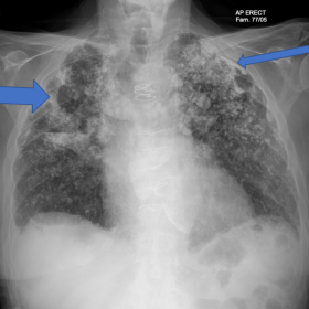 Chest radiograph of a patient with Berylliosis. Thick arrow: Upper lobe cavity formation and volume loss Thin arrow: High den