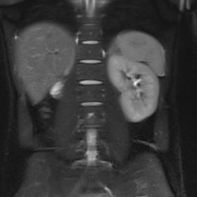 T2 weighted MRI coronal section showing right renal agenesis with normal left kidney
