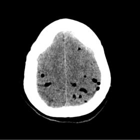 Axial Head CT at admission reveling intracranial air (pneumocephalus) in bilateral parietal sulci. Sulcal effacement is also 