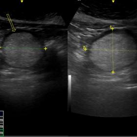 USG images showing intussusceptum(single arrow) within intussuscepiens (double arrow) with lipoma as its lead point (asterisk