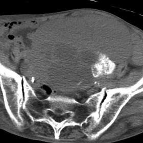Non-contrast CT of the abdomen reveals a large multilocular cystic mass with a large mural nodule containing dense calcificat