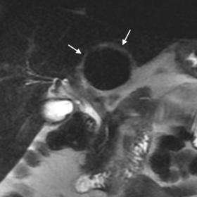 Coronal and axial T2 images showing a circumscribed, low-signal, extrahepatic mass (arrow in A; asterisk in B)