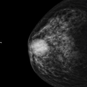 Right mammogram of the patient shows a retroareolar mass on both CC (A) and MLO (B) views. The mass is dense and shows a roun