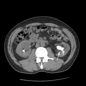 Staghorn stone in the left renal pelvis before percutaneous nephrolithotomy (arrow)