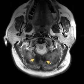 Axial T2 weighted image showing signal void (yellow arrow) around foramen magnum extending towards torcula