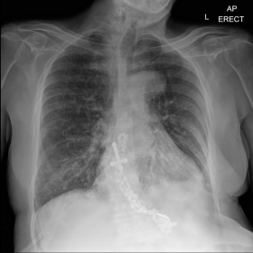 AP Chest X-ray showing ingested crucifix