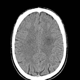 Non-contrast axial CT. Hypodense rounded lesion located in the left centrum semiovale. A closer inspection reveals a discrete