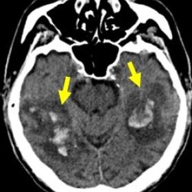 Brain CT revealed diffuse hyperdense intraparenchymal hemorrhagic lesions located on both temporo-occipital regions, accompan