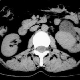 Nonenhanced CT image shows a lobulated solid well-circumscribed mass in the left renal sinus