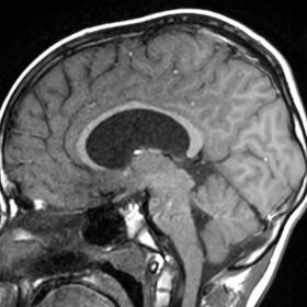 T1 sagittal image in midline shows a Large, midline, hypointense cyst below the corpus callosum extending from the rostrum to