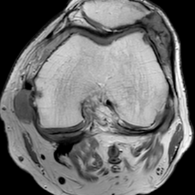 Axial proton density (PD) magnetic resonance imaging (MRI) of the left knee shows two heterogeneous intermediate-signal irreg