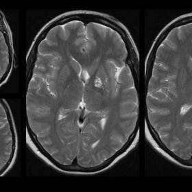 T2 MRI showing dilated perivascular spaces in the left peri commissural region