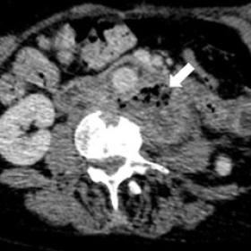 Venous phase CT image in axial plane showing left paravertebral collection containing gas (arrow)