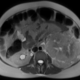 Axial T2 weighted HASTE image through the abdomen shows large heterointense infiltrative mass lesion noted involving the left