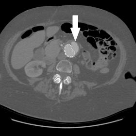 Axial contrast-enhanced CT showing an endoleak prior to glue embolization. The arrow points to the contrast filling the nativ