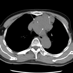 Unenhanced axial CT (a) revealed a lobulated, solid mass of the anterior mediastinum, with an unclear margin with the mediast