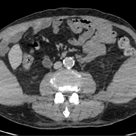 CT - showing enlarged muscles