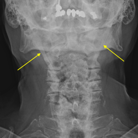 Frontal neck soft tissues radiograph shows elongation of the bilateral styloid bones and extensive ossification of the bilate