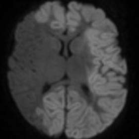 DWI and ADC show extensive diffusion restriction (cytotoxic edema) of the cerebral cortex with partial sparing of the right M