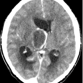 Contrast enhance CT. Hypodense intraparenquimatous lesion located in the right thalamus with peripheral enhancement and surro