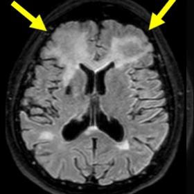 Axial FLAIR images show hyperintense coalescent PML lesions in the white matter of both frontal lobes. The lesions do not exh