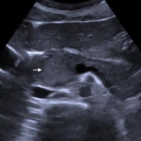 Ultrasound transverse image of the pancreas depicts slightly hyperechoic, homogeneous solid tumour in the pancreatic head (ar